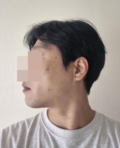 이마내시경거상 2주차, 미간주름 80프로 사라져 대만족 사진 4 — 아바성형외과 안면거상 후기