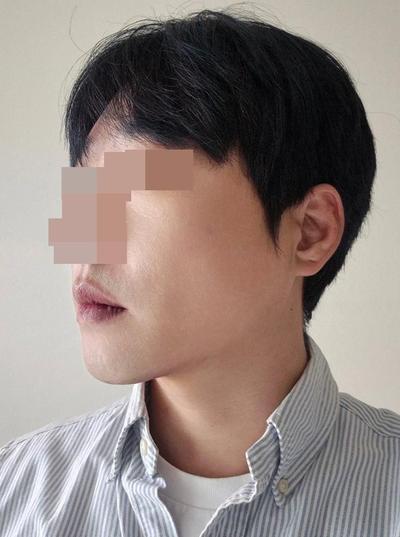 이마내시경거상 2주차, 미간주름 80프로 사라져 대만족 사진 5 — 아바성형외과 안면거상 후기