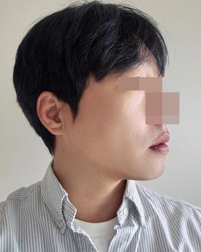 이마내시경거상 2주차, 미간주름 80프로 사라져 대만족 사진 6 — 아바성형외과 안면거상 후기