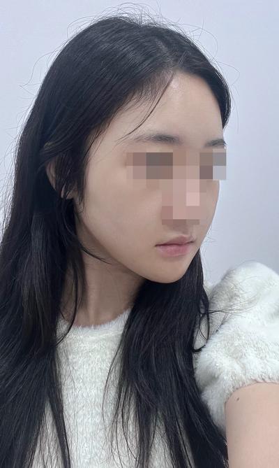 이중턱지방흡입＋민트실리프팅 3주차, 원하던 턱선 생겼어요 — 아바성형외과 환자 후기 사진