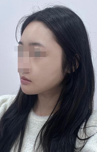 이중턱지방흡입＋민트실리프팅 3주차, 원하던 턱선 생겼어요 사진 4 — 아바성형외과 안면거상 후기