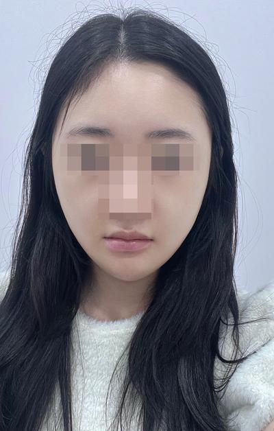 이중턱지방흡입＋민트실리프팅 3주차, 원하던 턱선 생겼어요 사진 5 — 아바성형외과 안면거상 후기