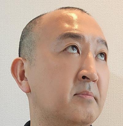 눈밑지방재배치 3주차, 다크서클 개선되고 인상 깔끔해졌어요 — 아바성형외과 환자 후기 사진