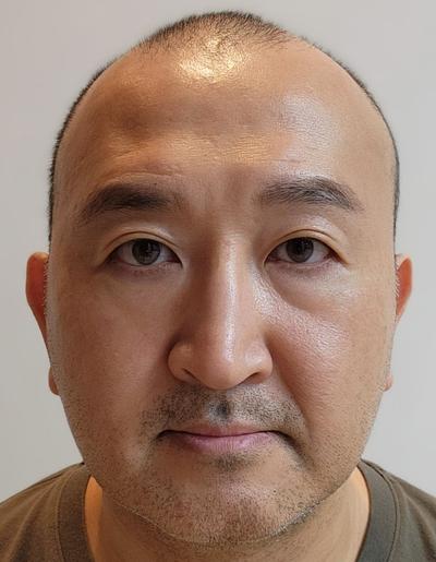 눈밑지방재배치 3주차, 다크서클 개선되고 인상 깔끔해졌어요 사진 3 — 아바성형외과 눈밑지방재배치 후기