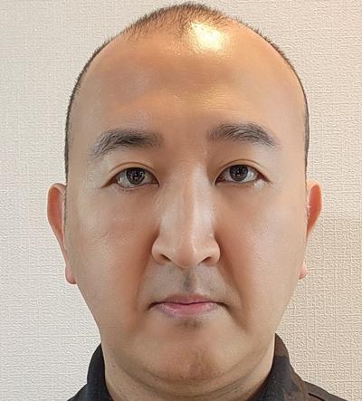 눈밑지방재배치 3주차, 다크서클 개선되고 인상 깔끔해졌어요 사진 4 — 아바성형외과 눈밑지방재배치 후기
