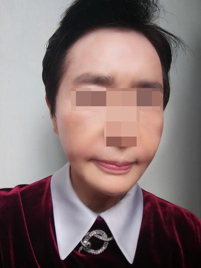 이마축소거상 2개월차, 눈 피로 줄고 젊어졌단 말 들어요 — 아바성형외과 환자 후기 사진