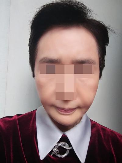 이마축소거상 2개월차, 눈 피로 줄고 젊어졌단 말 들어요 사진 3 — 아바성형외과 안면거상 후기