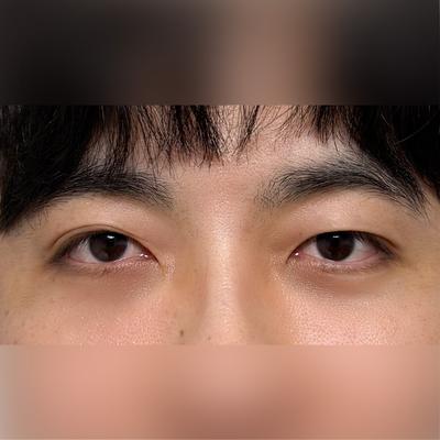 눈밑지방재배치 6주차, 외모 달라졌다는 말 자주 들어요 — 아바성형외과 환자 후기 사진