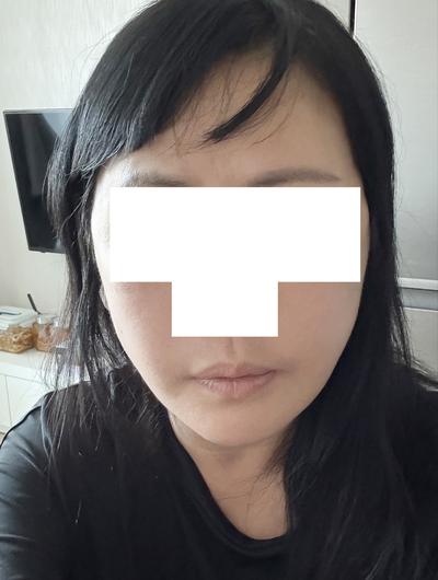 처져서 늙어 보였던 인상, 하고 나니 확 젊어졌어요 사진 2 — 아바성형외과 기타 후기