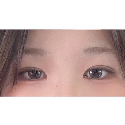 쌍꺼풀 절개 후기, 무쌍이라 힘들던 눈이 확 커지고 편해졌어요 — 아바성형외과 환자 후기 사진