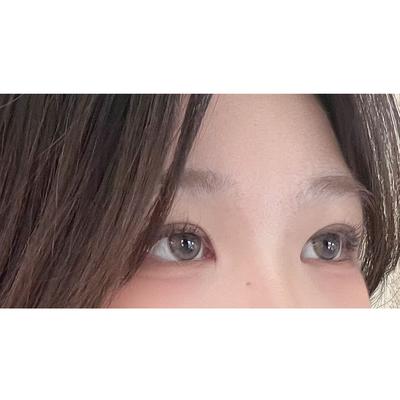 쌍꺼풀 절개 후기, 무쌍이라 힘들던 눈이 확 커지고 편해졌어요 사진 4 — 아바성형외과 쌍꺼풀·눈성형 후기
