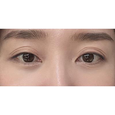 눈밑 수술 경과, 애교살까지 보이고 완전 자연스러워요 — 아바성형외과 환자 후기 사진