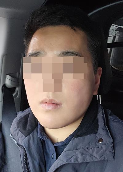 안면거상 8주차, 팔자주름 이중턱 사라져 기분 최고 — 아바성형외과 환자 후기 사진