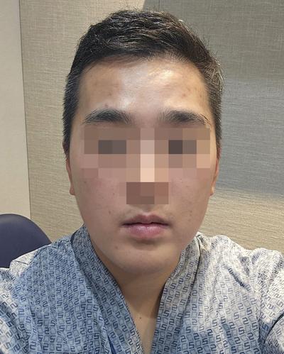 안면거상 8주차, 팔자주름 이중턱 사라져 기분 최고 사진 2 — 아바성형외과 안면거상 후기