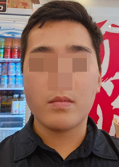 수술 6주차, 붓기 거의 없어지고 너무 만족해요 — 아바성형외과 환자 후기 사진