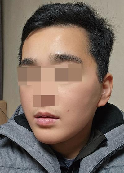 수술 6주차, 붓기 거의 없어지고 너무 만족해요 사진 4 — 아바성형외과 기타 후기