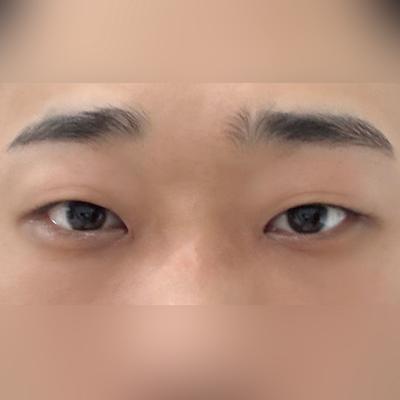 눈밑지방재배치 8주차, 뒤밑트임 재수술까지 성공했어요 — 아바성형외과 환자 후기 사진