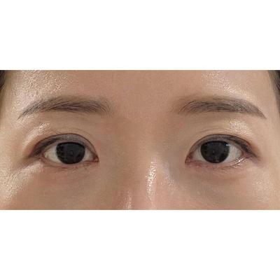 절개 쌍꺼풀 2개월차, 눈 또렷해지고 티 안 나게 자연스러워요 — 아바성형외과 환자 후기 사진