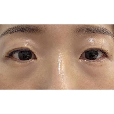 절개 쌍꺼풀 2개월차, 눈 또렷해지고 티 안 나게 자연스러워요 사진 2 — 아바성형외과 쌍꺼풀·눈성형 후기