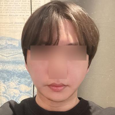 스마스거상＋아큐리프팅 7주차, 윤곽 또렷해져서 대만족 — 아바성형외과 환자 후기 사진