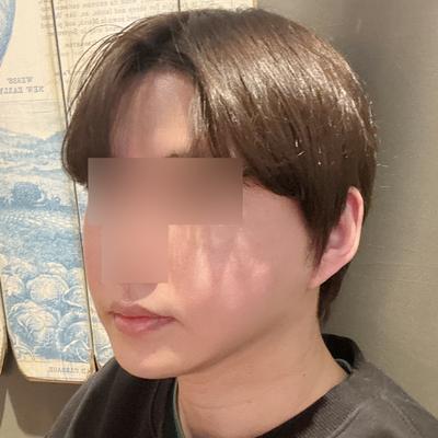 스마스거상＋아큐리프팅 7주차, 윤곽 또렷해져서 대만족 사진 5 — 아바성형외과 안면거상 후기