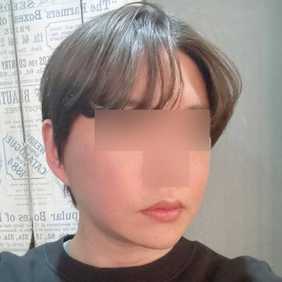 스마스거상＋아큐리프팅 7주차, 윤곽 또렷해져서 대만족 사진 6 — 아바성형외과 안면거상 후기