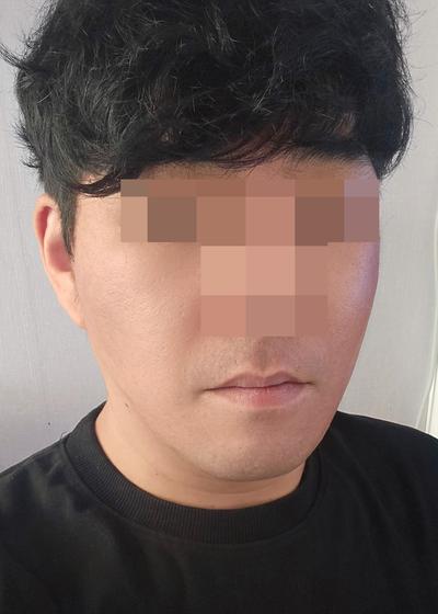 팔자주름 수술 8주차, 젊어졌다는 말 진짜 많이 들어요 — 아바성형외과 환자 후기 사진