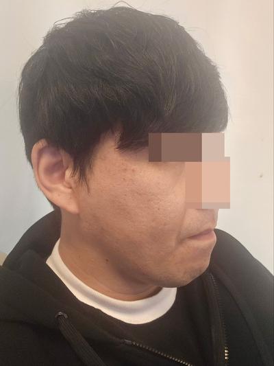 팔자주름 수술 8주차, 젊어졌다는 말 진짜 많이 들어요 사진 3 — 아바성형외과 기타 후기