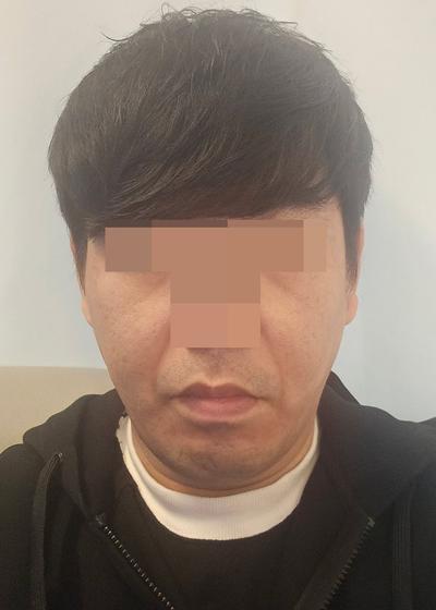 팔자주름 수술 8주차, 젊어졌다는 말 진짜 많이 들어요 사진 4 — 아바성형외과 기타 후기