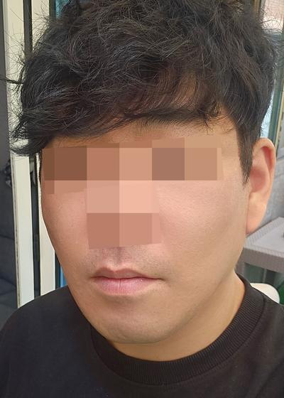 팔자주름 수술 8주차, 젊어졌다는 말 진짜 많이 들어요 사진 5 — 아바성형외과 기타 후기