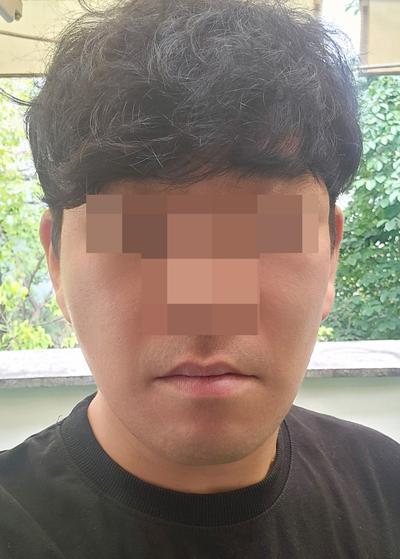 팔자주름 수술 8주차, 젊어졌다는 말 진짜 많이 들어요 사진 6 — 아바성형외과 기타 후기