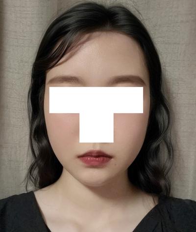 수술 9주차, 수술한 게 실감 안 날 만큼 편하고 만족 — 아바성형외과 환자 후기 사진