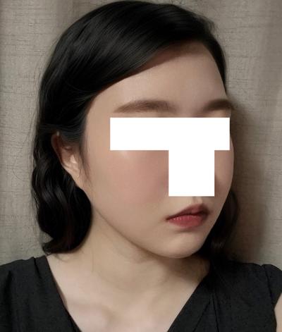 수술 9주차, 수술한 게 실감 안 날 만큼 편하고 만족 사진 5 — 아바성형외과 기타 후기