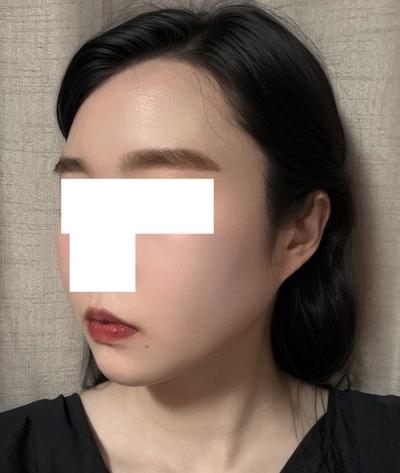 수술 9주차, 수술한 게 실감 안 날 만큼 편하고 만족 사진 6 — 아바성형외과 기타 후기