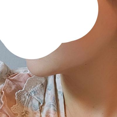기타 환자 후기 — 이중턱이 진짜 스트레스였어요... (5)