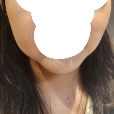 이중턱근육묶기 상담 후기, 과잉 하나 없어서 믿음 갔어요 사진 2 — 아바성형외과 이중턱·윤곽 후기
