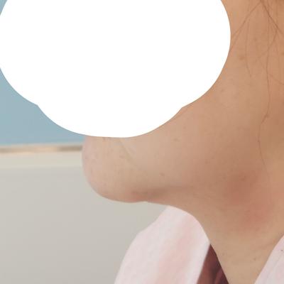 이중턱근육묶기 상담 후기, 과잉 하나 없어서 믿음 갔어요 사진 3 — 아바성형외과 이중턱·윤곽 후기