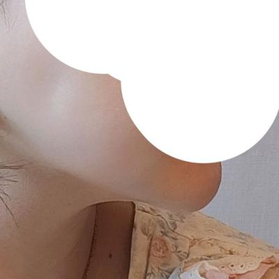 이중턱근육묶기 상담 후기, 과잉 하나 없어서 믿음 갔어요 사진 4 — 아바성형외과 이중턱·윤곽 후기
