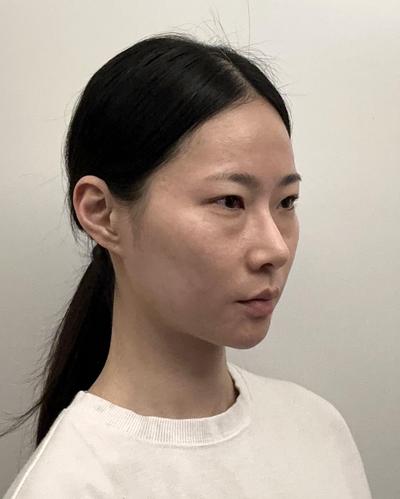 고민만 하다 한 수술, 진작 할 걸 후회해요 만족 만퍼센트 사진 2 — 아바성형외과 쌍꺼풀·눈성형 후기