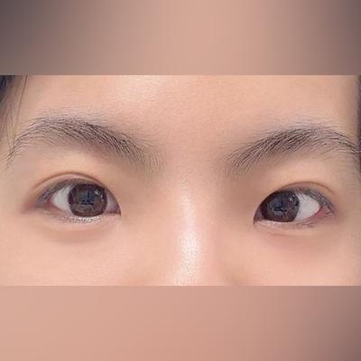 눈성형 환자 후기 — 브라운성형외과 김승수 원장님... (500)