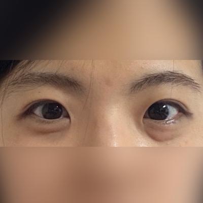 눈밑지방재배치 6주차, 어려 보인다는 말 진짜 많이 들어요 사진 2 — 아바성형외과 눈밑지방재배치 후기
