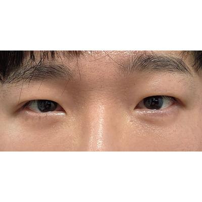 눈밑 시술 6주차, 불편함 없이 다 자리 잡았어요 — 아바성형외과 환자 후기 사진