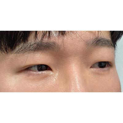 눈밑 시술 6주차, 불편함 없이 다 자리 잡았어요 사진 4 — 아바성형외과 눈밑지방재배치 후기