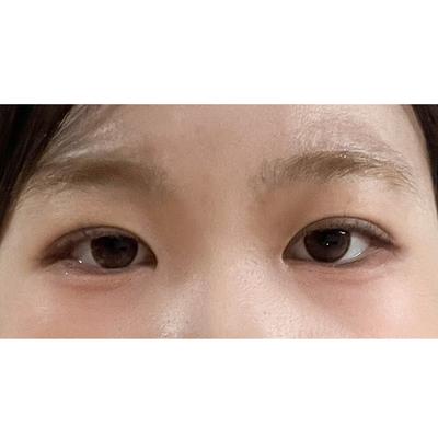 쌍꺼풀 8주차, 원했던 자연스러운 인아웃 라인 자리잡았어요 사진 4 — 아바성형외과 쌍꺼풀·눈성형 후기