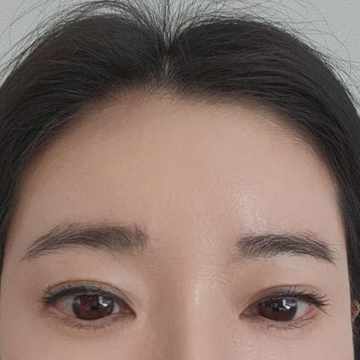 수술 6주째, 젊어져서 거울만 자꾸 보게 돼요 사진 4 — 아바성형외과 기타 후기