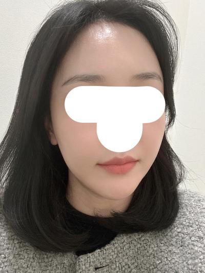 지방이식 환자 후기 — 풀페이스 지방이식 8주차 입... (52)