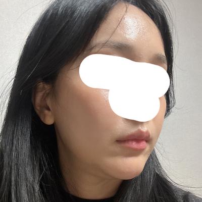 풀페이스 지방이식 8주차, 7주차에 2차 리터치까지 받았어요 사진 3 — 아바성형외과 지방이식 후기