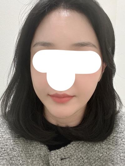 풀페이스 지방이식 8주차, 7주차에 2차 리터치까지 받았어요 사진 4 — 아바성형외과 지방이식 후기