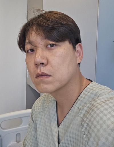 거상 12주차, 붓기 빠지니 흉터도 거의 안 보여요 대만족 사진 3 — 아바성형외과 안면거상 후기