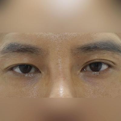 눈밑수술 수면마취 40분, 깨어나니 벌써 달라졌어요 사진 2 — 아바성형외과 눈밑지방재배치 후기